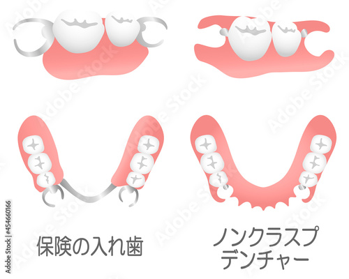 ノンクラスプデンチャーと保険の入れ歯（テキスト入り）