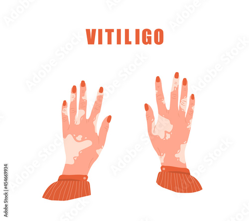 Female hands with vitiligo. World vitiligo day. Skin disease. Self care and self love. Vector illustration in flat cartoon style.