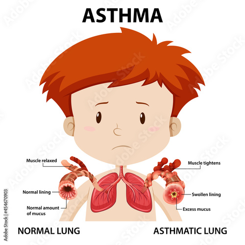 Asthma diagram with normal lung and asthmatic lung
