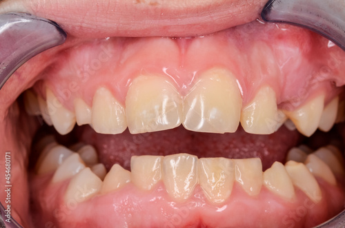 close up of incisor fillings at an teenager