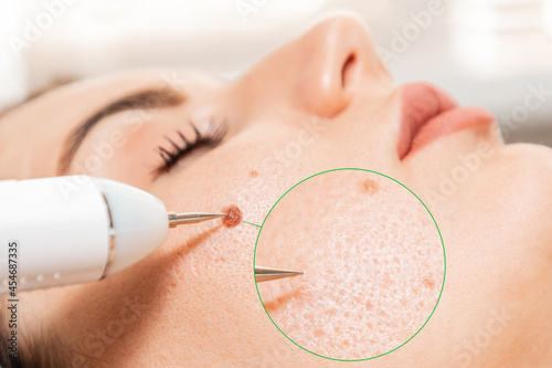 Electrocoagulation and laser cosmelotogy. Dermatologist surgeon using a professional electrocautery for removing mole. Comparison of results before and after operation