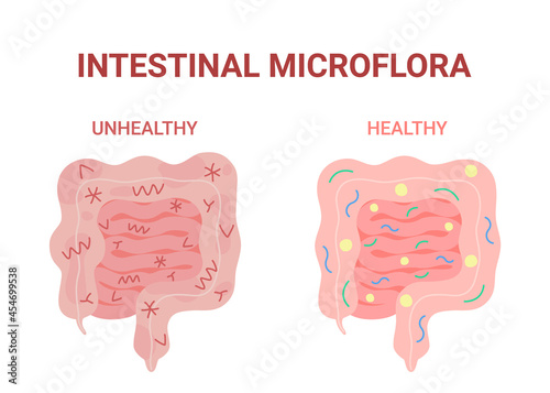 Healthy and unhealthy microflora intestinal, good and bad nutrition gut. Harmful and beneficial bacteria in inside gastrointestinal organ. Inflammation and pain internal digestive bowel. Vector