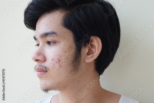 Young man 15 year old. With full face of acne problem or pimple on face Asian young boy