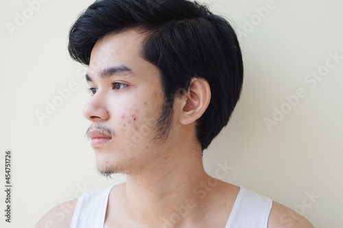 Young man 15 year old. With full face of acne problem or pimple on face Asian young boy