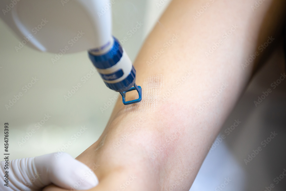 Laser hair or scar removal from the skin. CO2 technique. Stock Photo