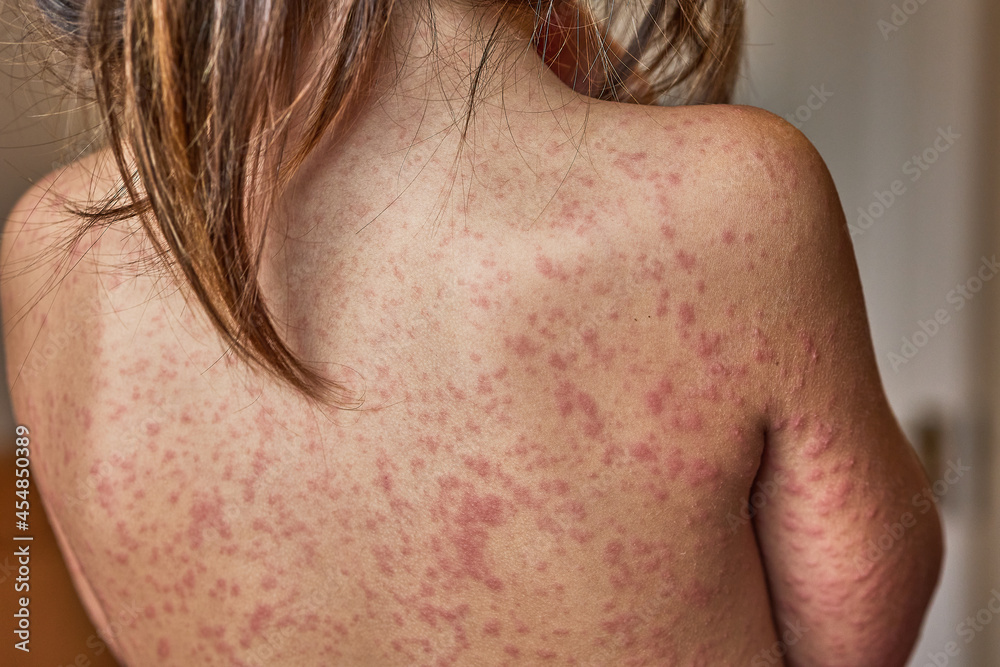 allergic rash on the body of the patient. 5 year old girl. allergic rash on the body of the patient. 5 year old girl.