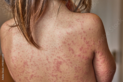 allergic rash on the body of the patient. 5 year old girl.  photo
