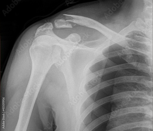 x ray of clavicula fracture and pneumothorax