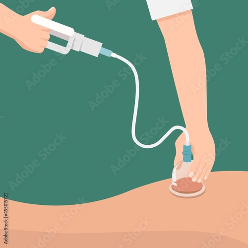 Vector illustration of a traditional medicine specialist doing Hijama or Cupping.	 photo