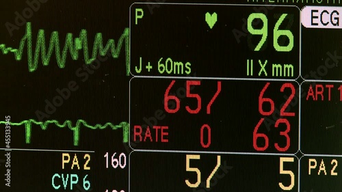 Wallpaper Mural vital signs monitor during surgery  Torontodigital.ca