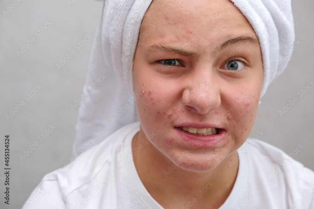 Acne. A teenage girl twisted her face, which she does not like because of acne. Acne. A teenage girl twisted her face, which she does not like because of acne.