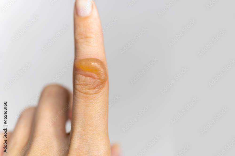 There is a blister on woman's hand from a burn. Burn of the finger. A