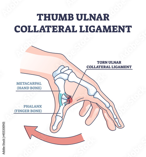 Thumb ulnar collateral ligament as finger injury and problem outline diagram. Labeled educational hand xray with bones and cartilage after medical condition and pain explanation vector illustration. photo