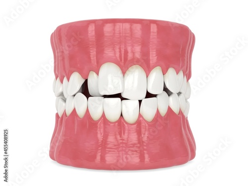 3d render of jaw with abnormal toothing isolated over white background