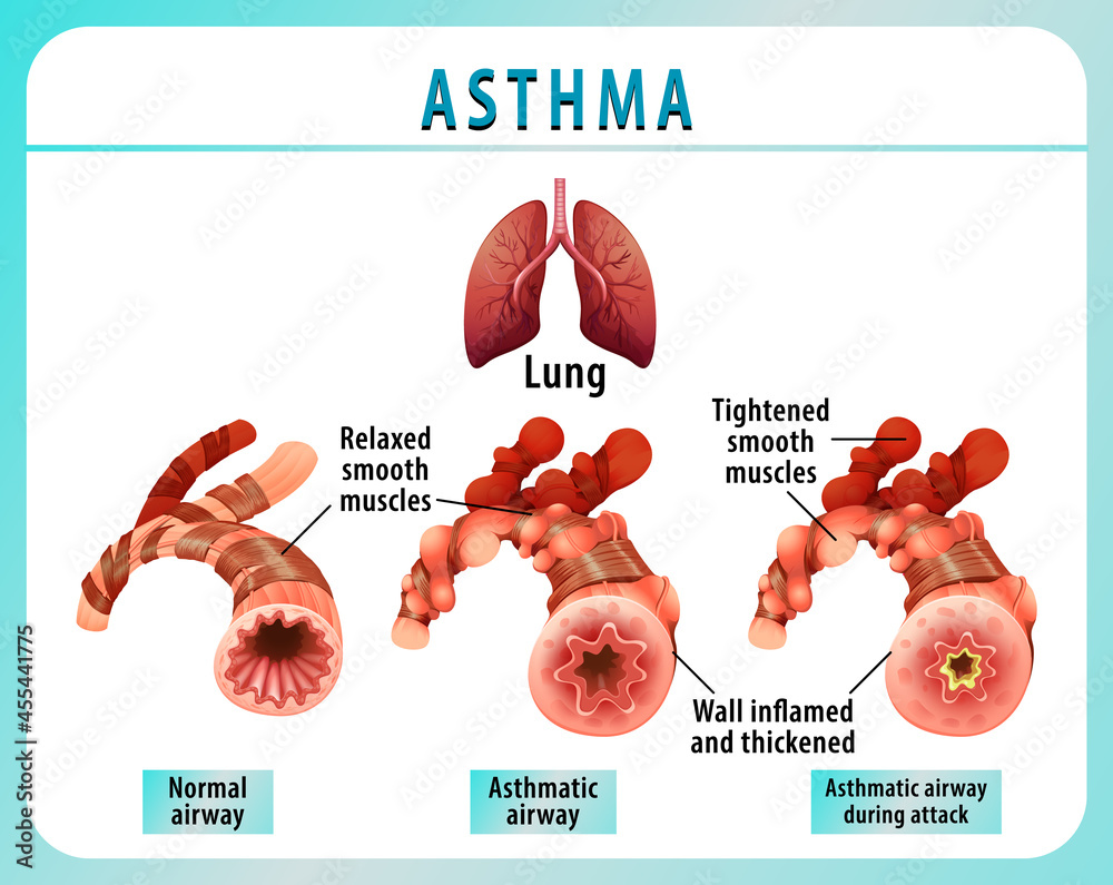 Bronchial Asthma diagram with normal airway and asthmatic airway vector