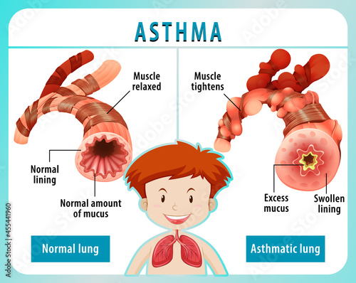 Asthma diagram with normal lung and asthmatic lung