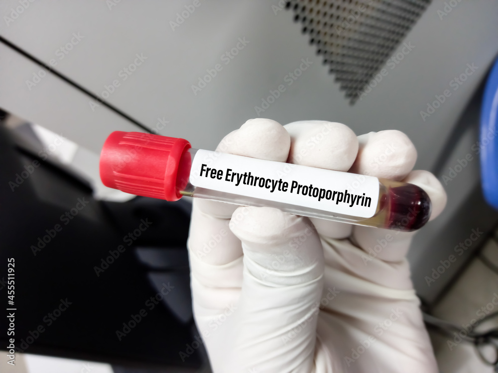 Blood sample tube for Free erythrocyte protoporphyrin or FEP test