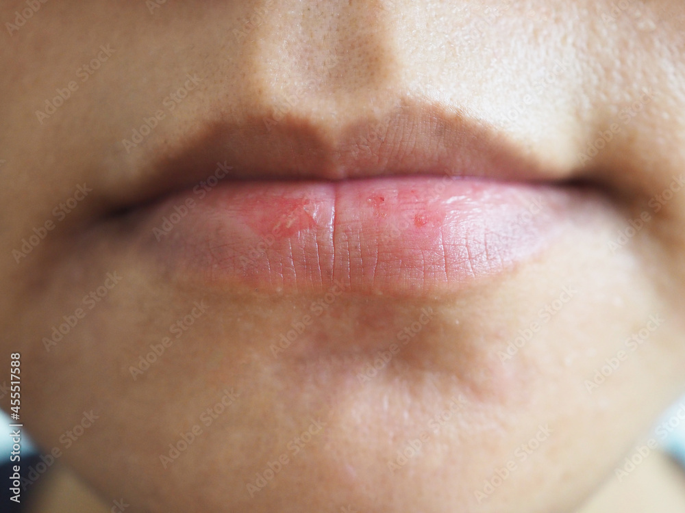 Obraz premium Asian woman lips cracked from wind, lack of vitamins. Sore from herpes virus. closeup photo, blurred.