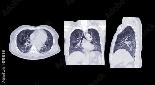 Foto Collection of CT scan of Chest or lung axial, coronal and sagittal view of lung infection covid-19 with ground glass opacity isolated on black background