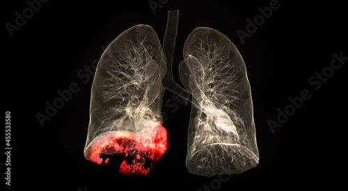 CT scan of Chest or lung 3d rendering image showing lung infection covid-19 at right lower lobe area isolated on black background. © samunella