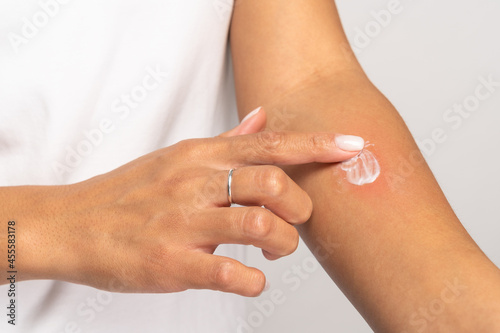 Allergic reaction, itch, allergy, dermatiti concept. Close up of woman applying cream or ointment on swell skin after insect mosquito bites, isolated on grey studio background.  photo