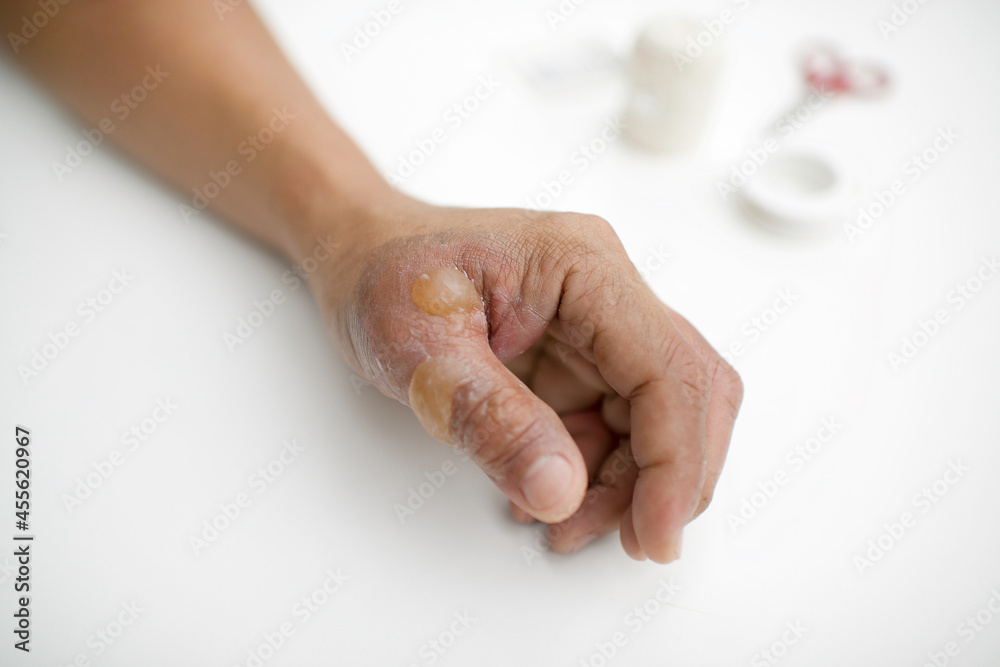 Patient's hand and thumb with heat blisters and injuries. Blister wound