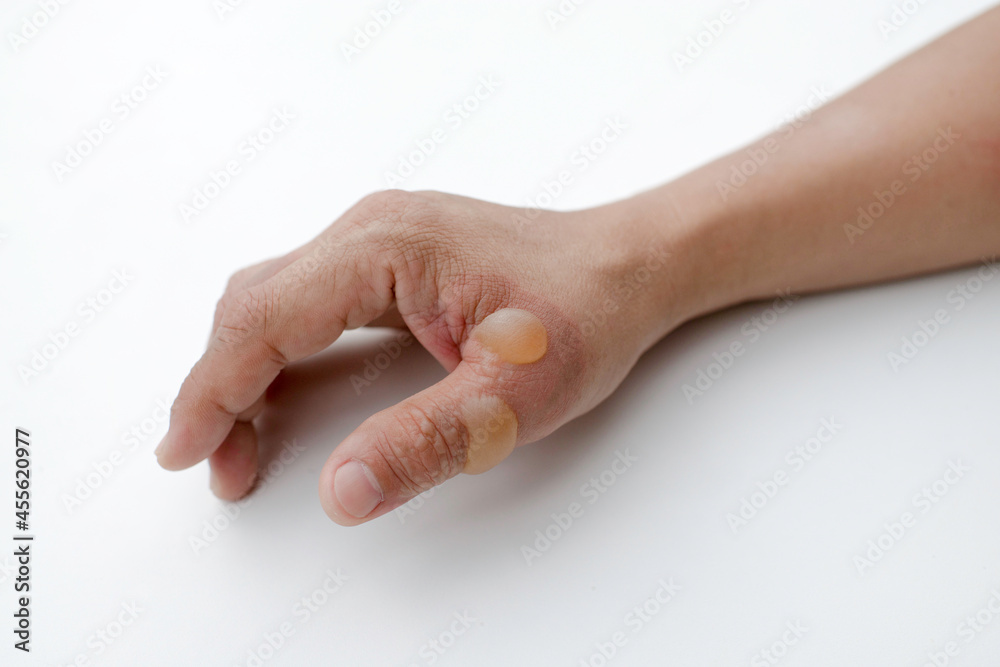 Patient's hand and thumb with heat blisters and injuries. Blister wound