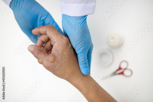 First aid treatment in patient with burn injury on hand and thumb. Doctor with gloves attending to a man's blisters.Bandage and scissor in background.Wound care in hospital.White background.