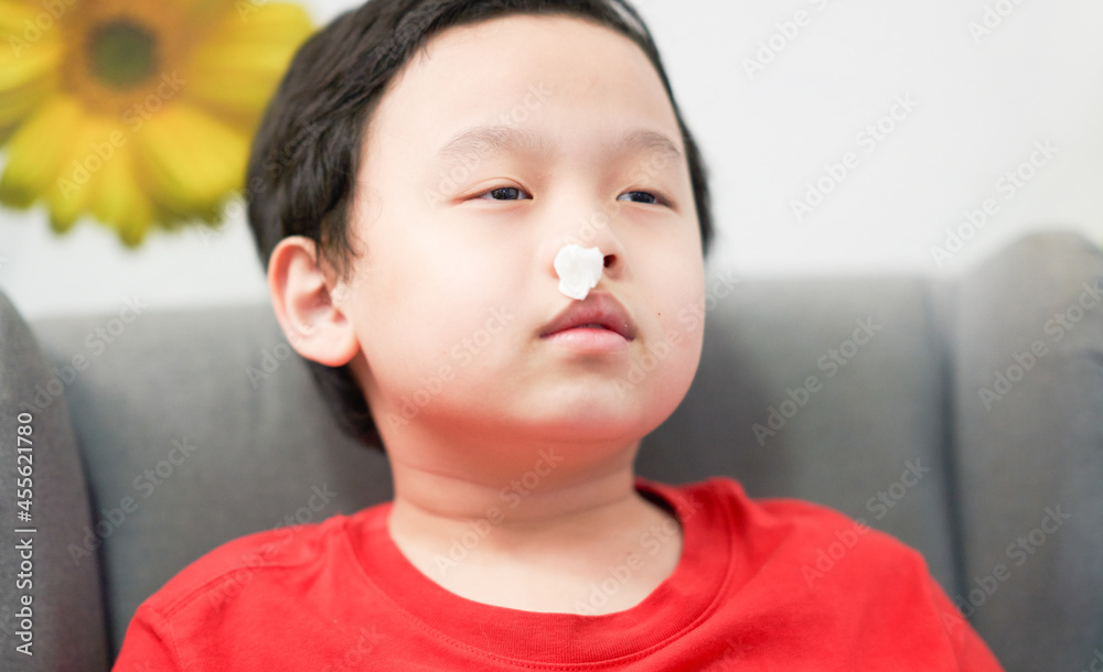 asian little boy nosebleed with gauze pack to stop epistaxis asian little boy nosebleed with gauze pack to stop epistaxis