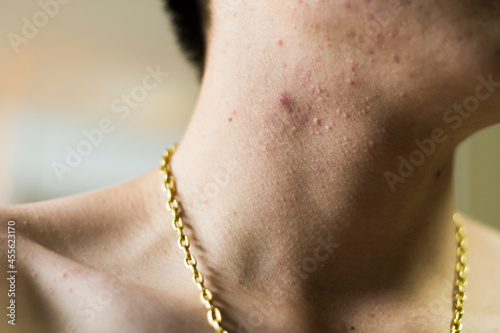 Close-up of a man wearing a gold necklace with lots of acne.