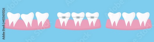  The concept of straightening teeth with braces. Result after wearing braces. Infographics.