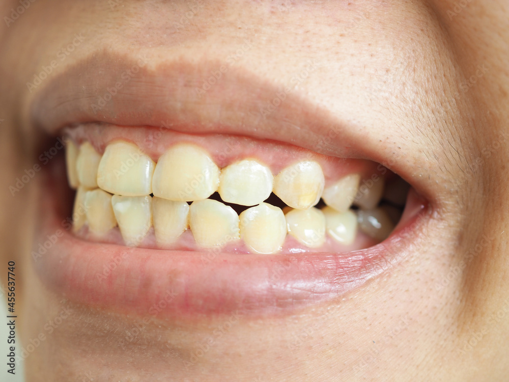 Obraz premium Yellow teeth of a woman. closeup photo, blurred.