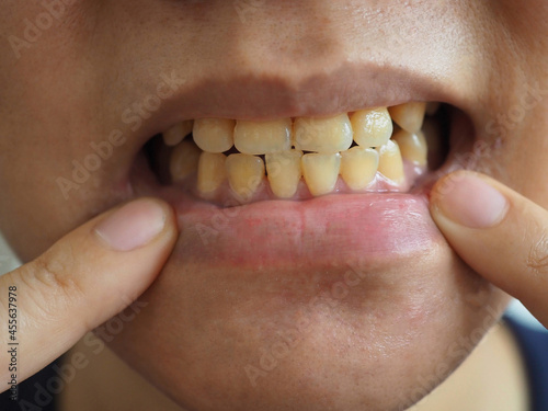 Yellow teeth problem. oral health concept. closeup photo, blurred.