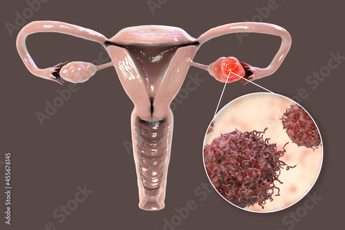 Ovarian cancer, 3D illustration photo