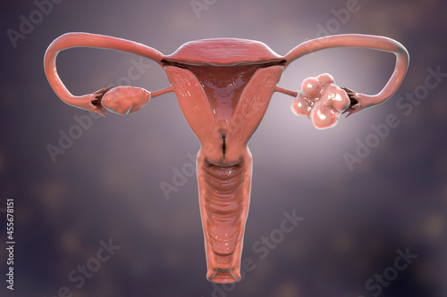 Polycystic ovary syndrome photo
