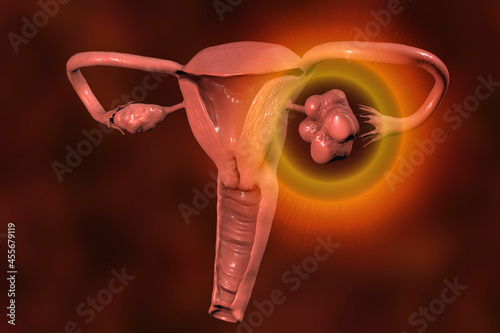 Polycystic ovary syndrome photo