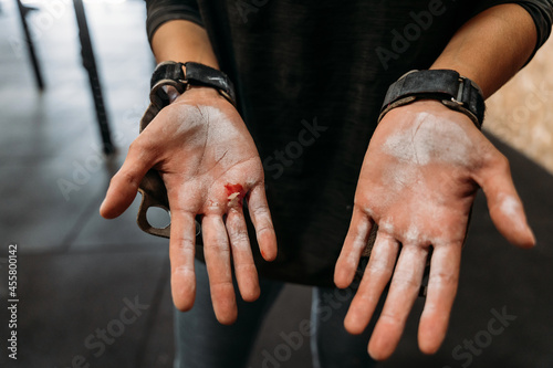 Crop sportswoman with injured hand after weightlifting training photo