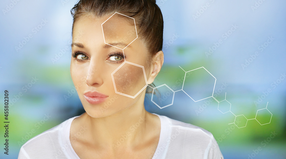 Dark spots, freckles,hyperpigmentation(melasma or chloasma),concept - skin lightening, skin whitening, fruit acids,AHA, Skin Brightening. Dark spots, freckles,hyperpigmentation(melasma or chloasma),concept - skin lightening, skin whitening, fruit acids,AHA, Skin Brightening.