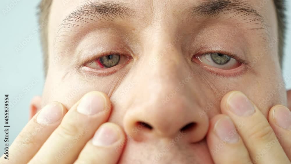 close-up of a man with red sore eyes raising eyelids with fingers looking at the camera. close-up of a man with red sore eyes raising eyelids with fingers looking at the camera.