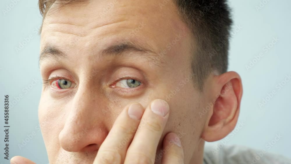 man with red eyes raising eyelids with fingers looking at the camera. man with red eyes raising eyelids with fingers looking at the camera.