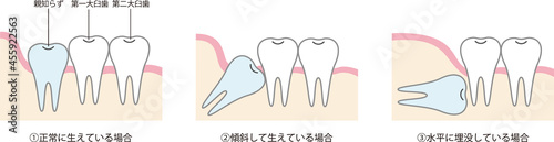 親知らずのイラスト