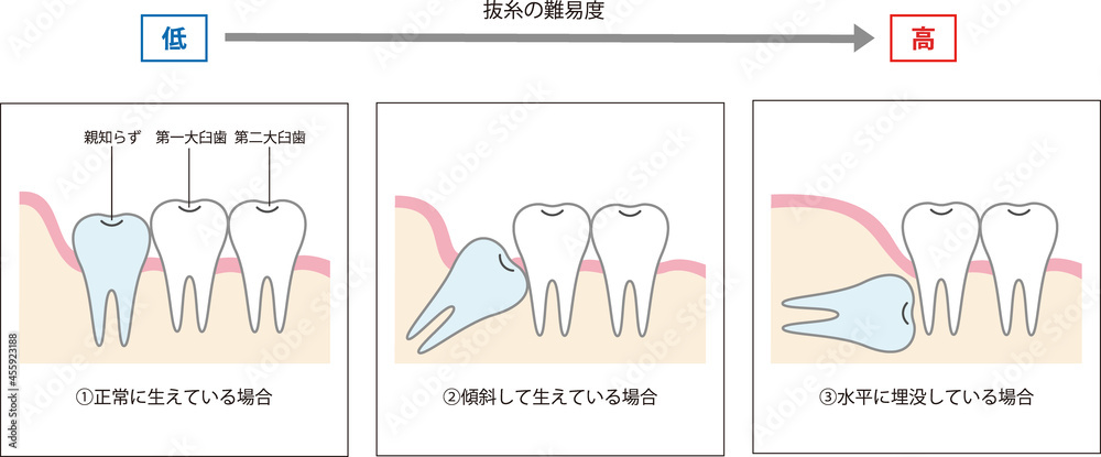 親知らずのイラスト Stock Vector Adobe Stock