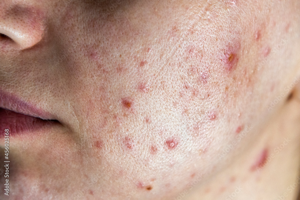 Fototapeta premium Closeup of woman face with bad skin and red acne