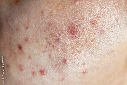 Closeup of woman face with bad skin and red acne