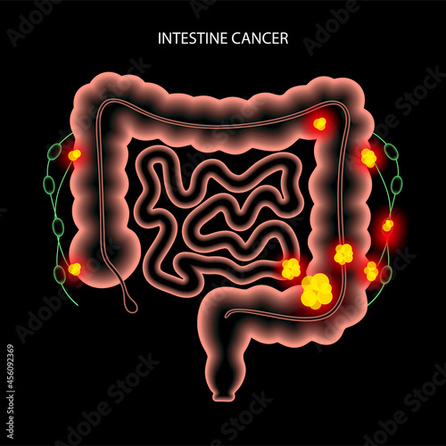 Intestine 3D cancer
