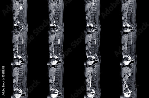 MRI spine showing mass at distal cord and conus medullaris, with tumor seedings at lower spinal canal. The mass appear hypersignal T2 and strong enhancement. DDx. Myxopapillary ependymoma photo