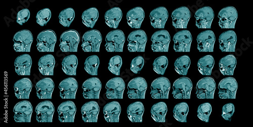 Magnetic resonance imaging Finding  5 cm isodense mass with ill-defined margin and surrounding edema at Left frontal lobe. Glioblastoma, brain metastasis.science and education mri brain background. photo