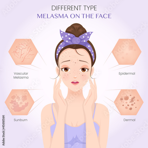 Different type melasma on the face photo
