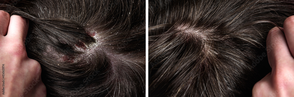 Before and after dandruff treatment shampoo on hair woman. Dandruff in the hair. Flaky scalp. Seborrhea. - obrazy, fototapety, plakaty 