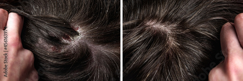 Before and after dandruff treatment shampoo on hair woman. Dandruff in the hair. Flaky scalp. Seborrhea. photo